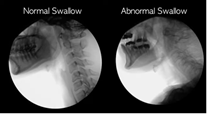 Dysphagia videofluoroscopy 